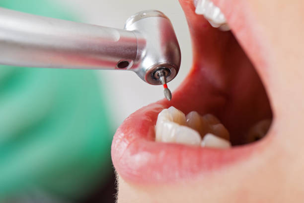 Best Knocked-Out Tooth (Avulsed Tooth) Treatment in Austin, AR